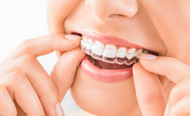 Dental Implant in Richmond Town, Bangalore