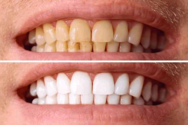 Whitening for Sensitive Teeth