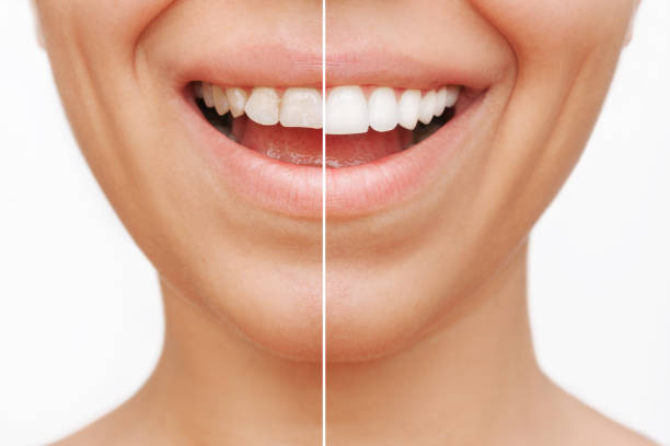 Benefits of Veneers