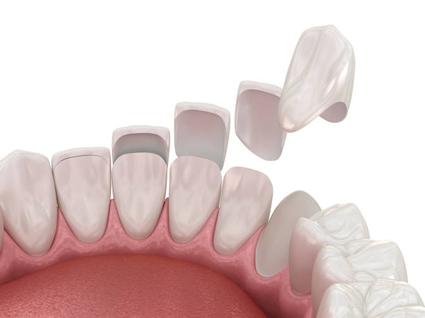 Zirconia Veneers