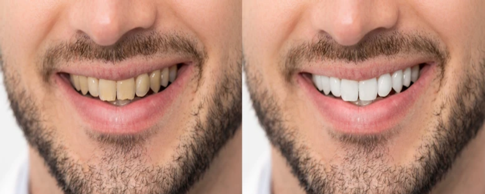 What is the Cost of Teeth Whitening in Richmond Town, Bangalore?